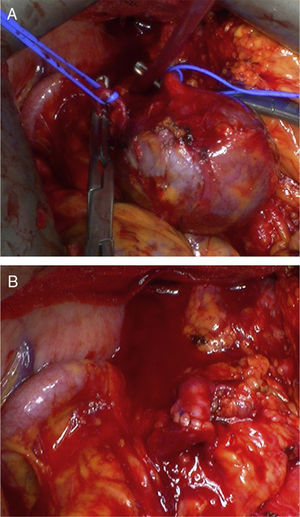 Intraoperative images: (A) SAA in the omental sac and (B) end-to-end arterial reconstruction.