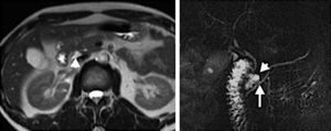 Nuclear magnetic resonance (sequence T2) showing a cystic image located in the posterior region of the head of the pancreas that communicated with the duct of Wirsung.