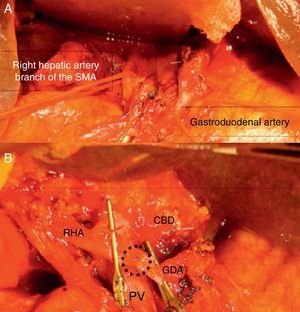 (A) Dissection of the aberrant right hepatic artery and the gastroduodenal artery; (B) end-to-end anastomosis, with the aberrant right hepatic artery (RHA), gastroduodenal artery (GDA), portal vein (PV), common bile duct (CBD). The broken line indicates the anastomosis between the RHA and the GDA.