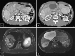 (A) Abdominal computed tomography (CT) with contrast showing the presence of multiple adenomas with enhancement in the arterial phase, occupying practically the entire liver parenchyma; (B) CT with adenomatous lesion, heterogeneous due to intratumoral bleeding in segment IV; (C) magnetic resonance imaging (MRI) enhanced in T1 with saturation of the fat, which shows evidence of hyperintense lesion in segment VIII due to the intralesional hemorrhagic component; (D) MRI enhanced in T2 with saturation of the fat: 2 lesions are identified, one hyperintense with cystic component in segments V–VI, and another isointense lesion in segment III, a typical characteristic of hepatic adenoma.