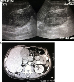(A) abdominal ultrasound showing the gallbladder with solid content; (B) abdominal CT showing the distended gallbladder.