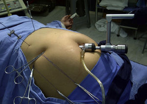 Laparoscopic cholecystectomy with a 12mm umbilical port, aided by reins and percutaneous needles.