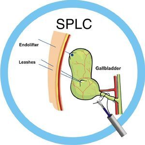 Diagram of the single-port cholecystectomy assisted with 2 leashes.