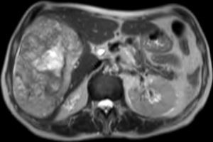 Voluminous liver mass (18cm×12cm) in the right liver lobe with intralesional bleeding.