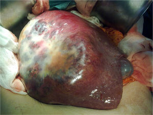 Tumor occupying the entire right liver lobe from the right dome of the diaphragm to the pelvis, with elastic consistency and violet color.