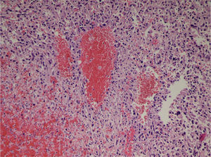 The microscopic study of the surgical specimen reveals a neoplastic proliferation of epithelioid cells with atypia forming nests or vascular structures interspersed with areas of hemorrhage and necrosis, showing cellular uptake with vascular markers (CD31, CD34, F.VIII), compatible with high-grade angiosarcoma.