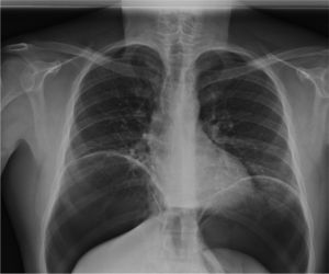 Posteroanterior chest radiograph in standing position: observe the pneumoperitoneum that displaces both domes of the diaphragm and pushes the abdominal viscera outwards.