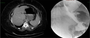 Abdominal CT (left) showing the intra-abdominal abscess secondary to a gastric fistula; upper GI series (right) with leak of contrast material on the upper third of the LSG.