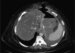 Abdominal CT with a large perigastric collection and left pleural effusion secondary to the gastric fistula.