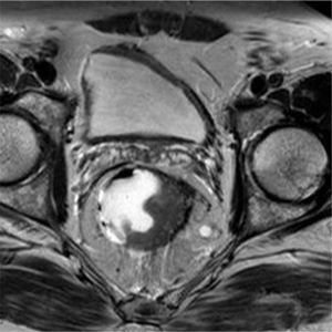 Pelvic MRI: axial slice at the femur heads showing a narrow pelvis and neoformation in the mid-rectum.