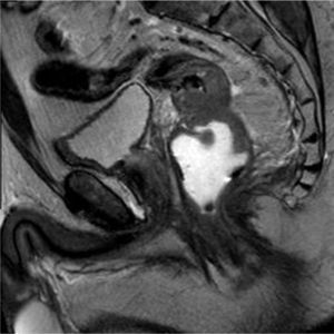 Pelvic MRI: sagittal cut with voluminous neoformation in the mid-rectum.