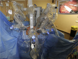 Robot anchored in the abdomen from the left side of the patient.