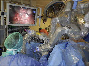 Robot anchored in the transanal port over the left hip of the patient.