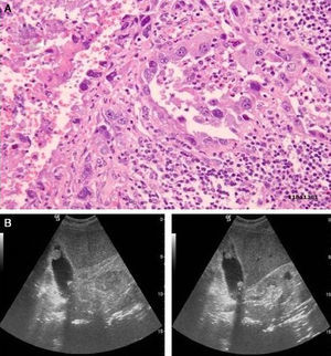 Anaplastic biliary gallbladder carcinoma. (A) Epithelial neoplastic growth, with intense nuclear pleomorphism and low tendency to be present in glands, H–E, 250×. (B) Stage T2. Ultrasound scan of polypoidal intraluminal mass with focal wall thickening.