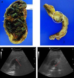 moderately differentiated carcinoma (T2). (A) Open gallbladder invaded by multiple faceted stones on a necrotic bed. Imaging of the gallbladder section in the background. A neoplasm infiltrating the muscular layer can be observed. (B) Diffuse and irregular gallbladder wall thickening with non-uniform echoes and acoustic shadow content.