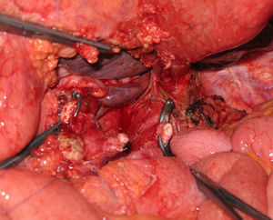 Total duodenopancreatectomy with resection of superior mesenteric artery (1).