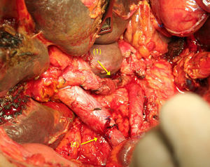 Total duodenopancreatectomy with resection of the coeliac trunk (1) and superior mesenteric vein (2).