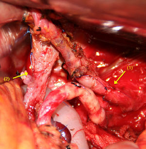 Total duodenopancreatectomy with resection of the coeliac trunk.