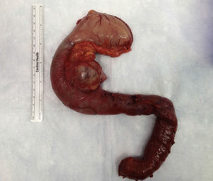 Surgical specimen from the pancreaticoduodenectomy including the mass located in the head of the pancreas.