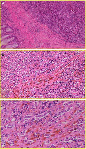 Anorectal melanoma. (A) Relationship of neoplasm with the muscular layer (HE 10×). (B) High polymorphism and cellular anaplasia (HE 20×). (C) Anisokaryosis, evident nucleoli and melanin pigment (HE 40×).