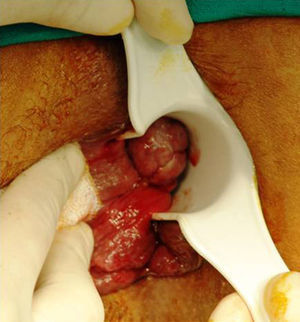 Anorectal melanoma. Clinical appearance.