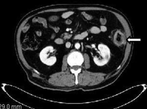 CT: Tumor in the descending colon with reaction of the perilesional mesenteric fat and in close relationship with the parietal peritoneum.