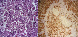 (A) Histology: hematoxylin–eosin stain (400×). Solid sheet of cells with extensive eosinophilic cytoplasm, with large vesicular, eccentric nuclei that give the cells a rhabdoid appearance. (B) Histology: cytokeratin cocktail (100×); positive neoplastic cells with cytokeratin. Note the internal control of the normal colonic epithelium.
