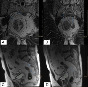 (A and B) Coronal MRI scans where the radiological characteristics of the lesions can be observed; (C and D) Sagittal MRI scans showing how the lesions are in contact with the sacrum and rectum, which would explain the patient's symptoms.