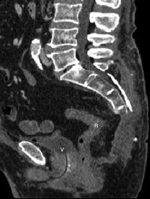 Sagittal CT reconstruction showing: distal sacrectomy, absence of the resected lesions and seroma in the surgical bed.