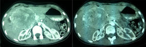 Abdominal CT: large tumor in the hepatic hilum.