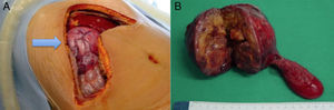 Surgical specimen: carcinoid tumor in the bile duct.