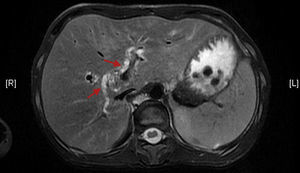 Magnetic resonance in T2: intrahepatic lithiasis distributed bilaterally in both liver lobes.