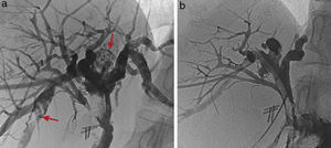 (a) Preoperative percutaneous transhepatic cholangiography (PTC): dilatation of the intrahepatic bile duct with multiple bilateral calculi in both liver lobes; (b) Postoperative PTC: absence of hepatolithiasis with adequate passage of the contrast through the hepaticojejunostomy.