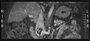 MRI angiography demonstrating invasion of the IVC by the thrombus.