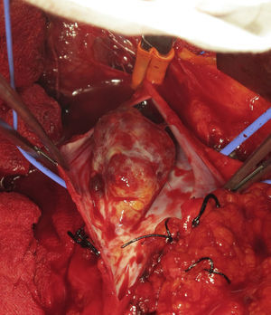 Resection of the vena cava with the tumor thrombus.