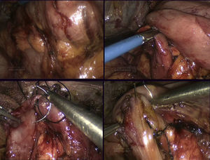 Monoplane manual side-to-side duodenoduodenal anastomosis with 2/0 silk sutures.