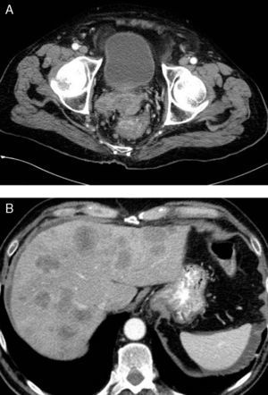 (a, b) Locally advanced rectal neuroendocrine carcinoma with liver metastases.