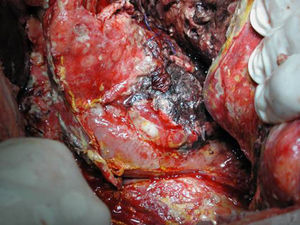 Pancreatic head necrosectomy during the first week from onset.