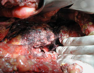 Pancreatic body and tail necrosectomy at 4 weeks from onset.