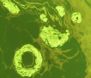 Thioflavin stain; the yellow-green accumulations are amyloid substance deposits (thioflavin stain, ×10).