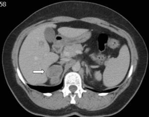 Abdominal CT scan with contrast showing a right suprarenal mass with a maximum diameter of 5cm.