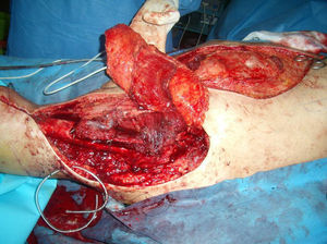 Radical resection with margins of the anterior compartment of the left thigh and cortical anterior of the femur, with reconstruction using free fibula flap and pedicled VRAM flap in the inferior epigastric vessels.