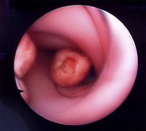 Choledochoscopy image: chick peas in the aorta lumen.
