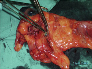 Five-minute massage and mesocolon dissection.
