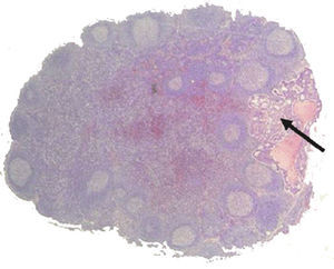 Micrometastasis located in a sentinel lymph node.