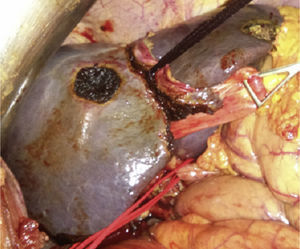 Knotted tourniquet after it was run between the middle and left liver veins, and extraglissonian at the left liver pedicle. The left liver artery remains tagged.