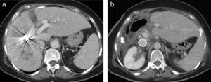 (a) CT on 7th right portal vein post-embolization day shows coils in the portal vein anterior branch and hypertrophy of the anatomical left liver lobe (segments II-III) (77% increase in volume). This is a view of the tourniquet print and absence of vascularization through it (arrow). (b) Control CT at 18 months after surgery shows the Gore-Tex graft in the inferior vena cava and absence of tumor relapse.
