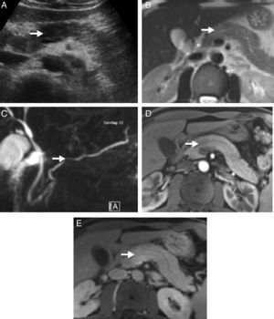 Radiological images of a pancreatic mass-shaped, painless jaundice-related autoimmune pancreatitis (AIP) patient. (A) Abdominal ultrasound showing a hypoechoic focal area in the head of the pancreas compared to the rest of the gland. (B) Magnetic resonance scan T2 potentiated sequence showing a focal area with signal increase in the same area of the pancreas, lacking clear contour distortion and gland enlargement. (C) Cholangiographic sequences showing mild focal stenosis in pancreatic conduit size, which remains permeable and does not cause proximal dilation. (D) Pancreas focal area appears less emphasised than the adjacent parenchyma in the arterial phase of the dynamic analysis; (E) shows greater enhancement in delayed phases.