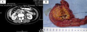 (A) CT scan showing a predominantly cystic mass in the topography of the uncinate process (arrow); and (B) pancreaticoduodenectomy surgical specimen with cystic mass (arrow).