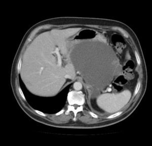 Abdominal CT scan showing pancreatic pseudocyst compressing the stomach.